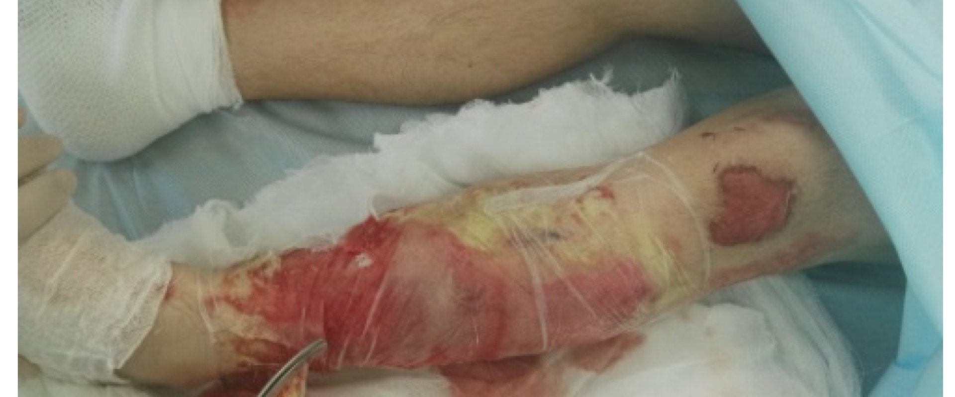 The Importance of Wound Debridement for Proper Healing