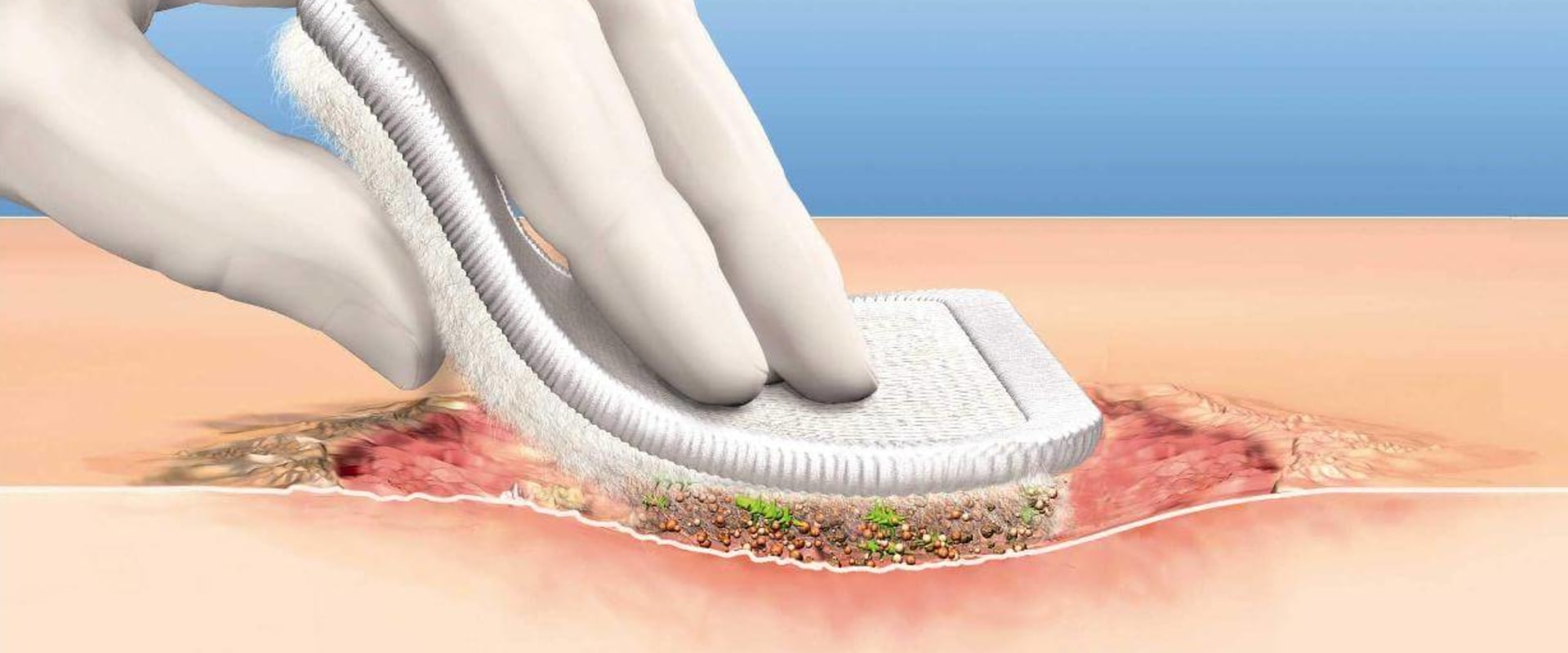 The Importance of Wound Debridement for Optimal Healing