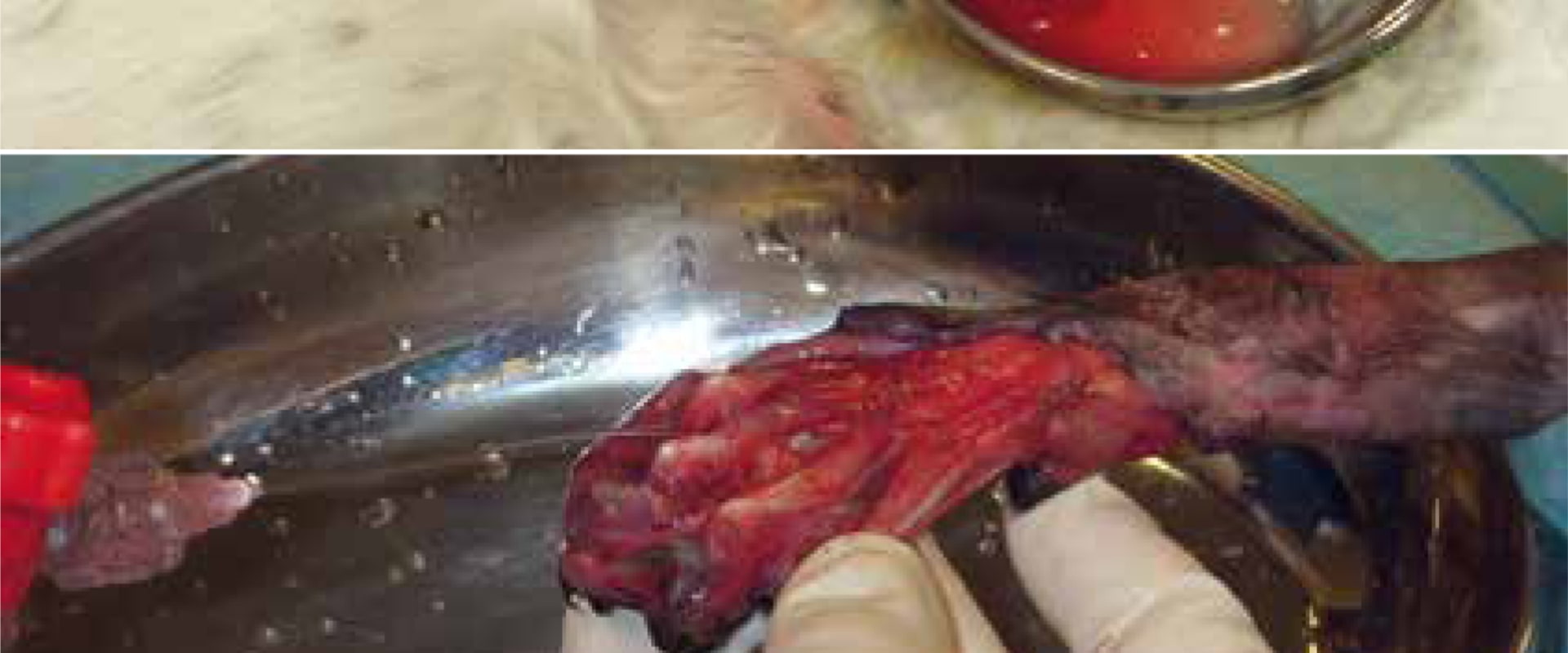 The Importance of Anesthesia in Wound Debridement