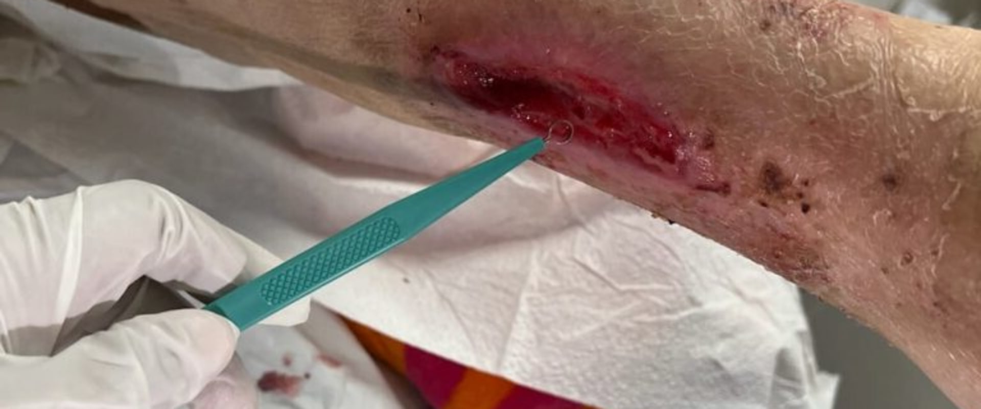 The Importance of Wound Debridement for Proper Healing