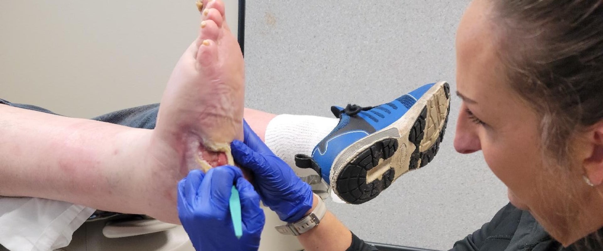 The Importance of Debridement in Wound Healing