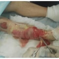 The Importance of Wound Debridement for Proper Healing