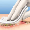 The Importance of Wound Debridement in the Healing Process