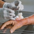 The Importance of Debridement in Wound Care