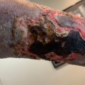 The Importance of Debridement for Infection Control