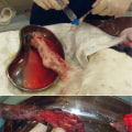 The Importance of Anesthesia in Wound Debridement