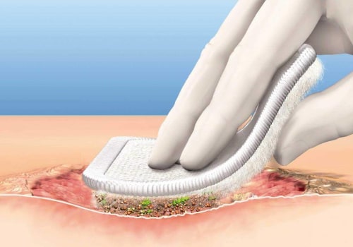 The Importance of Wound Debridement for Optimal Healing