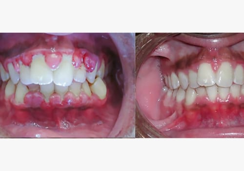 The Importance of Anesthesia in Debridement Procedures