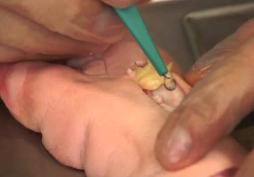 Managing Yellow Wound Healing Slough Tissue Through Expert Debridement Techniques